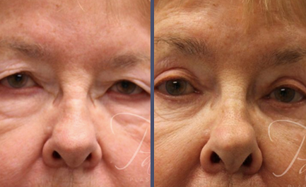 Before and After Results
