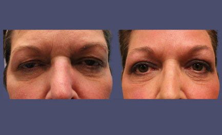 Before and After Results