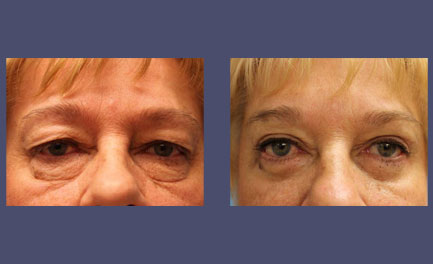 Before and After Results