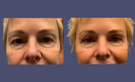 Before and After Results
