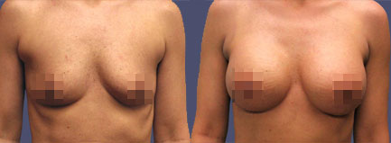 Before and After Results