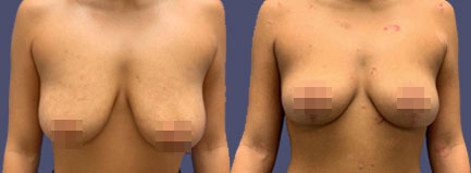 Before and After Results