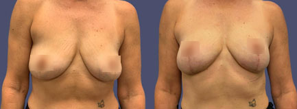 Before and After Results