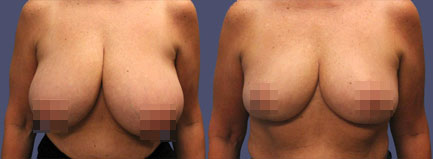 Before and After Results