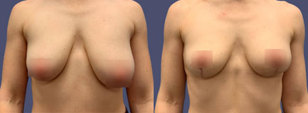 Before and After Results