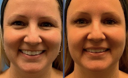 Before and After Results