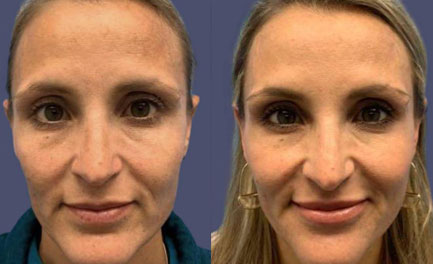 Before and After Results