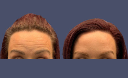 Before and After Results