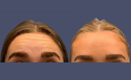 Before and After Results