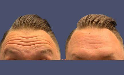 Before and After Results