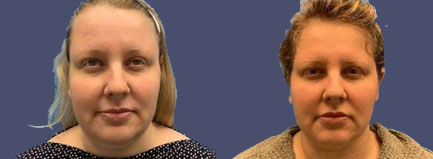 Before and After Results
