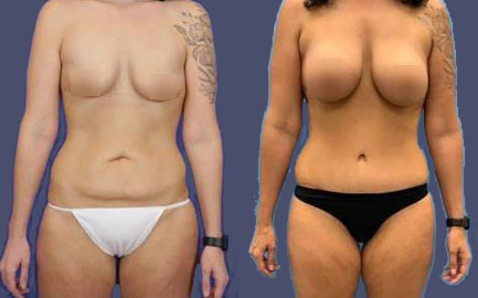 Before and After Results