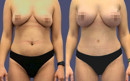 Before and After Results