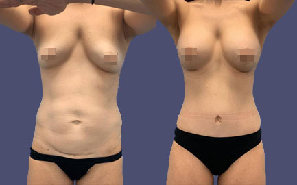 Before and After Results