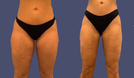 Before and After Results