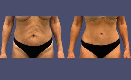 Before and After Results