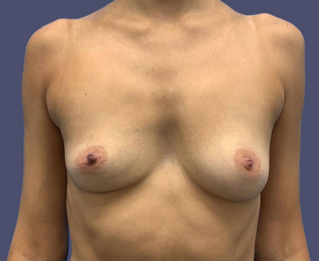 Breast Augmentation 21 Before