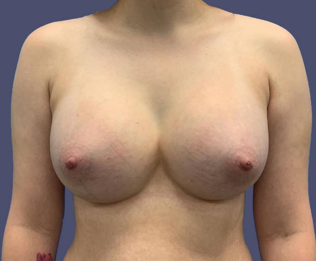 Breast Augmentation 10 After