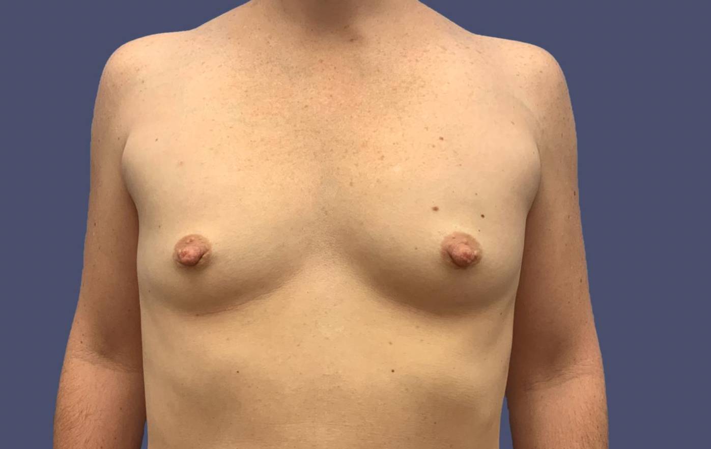 Breast Augmentation 25 Before