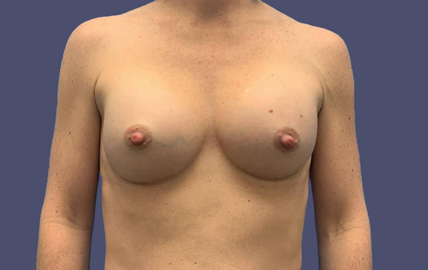 Breast Augmentation 25 After
