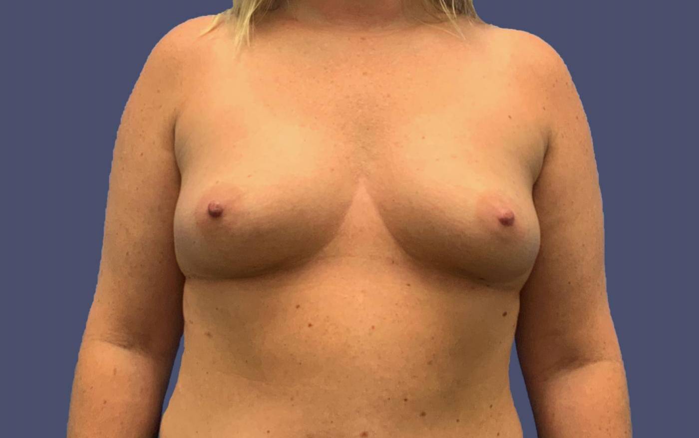 Breast Augmentation 28 Before