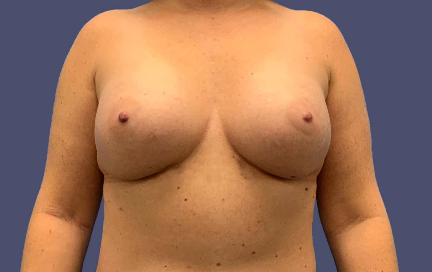 Breast Augmentation 28 After