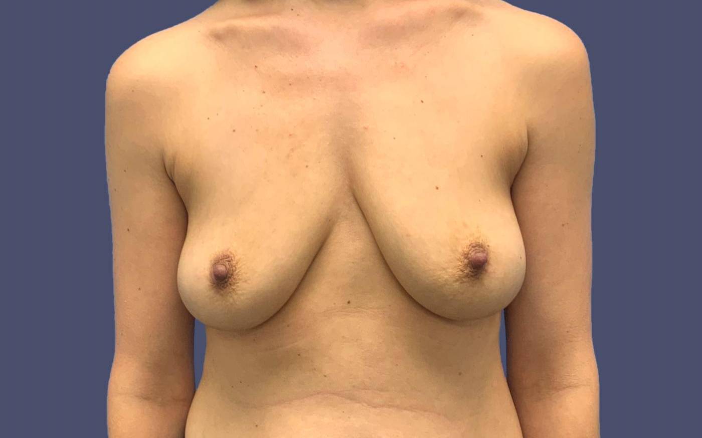 Breast Augmentation 35 Before
