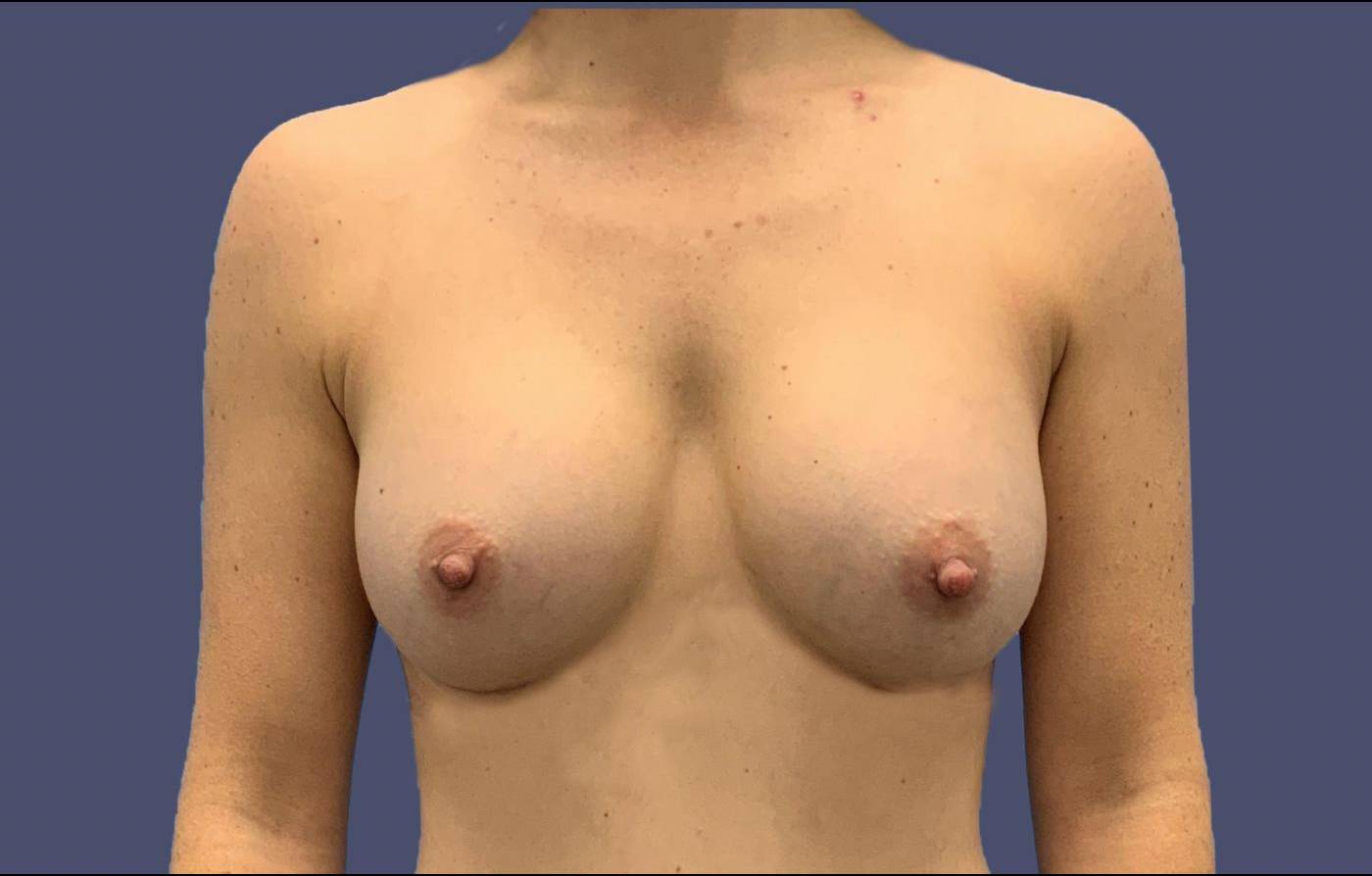 Breast Augmentation 30 After