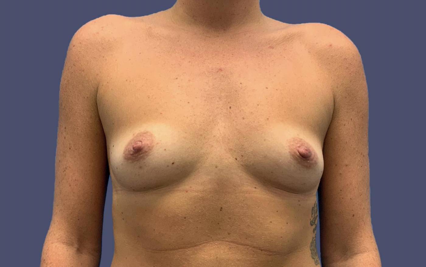 Breast Augmentation 18 Before