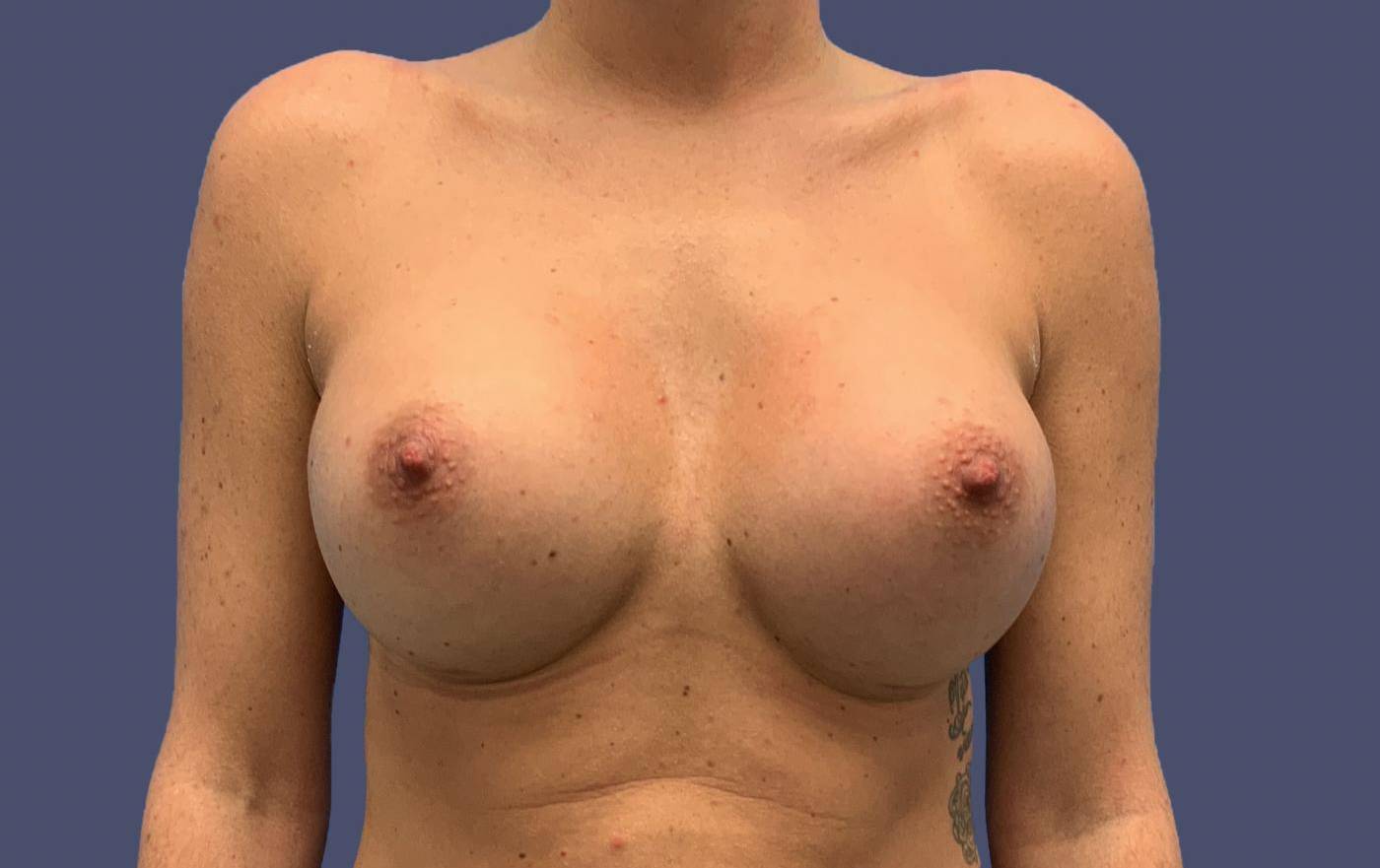 Breast Augmentation 16 After