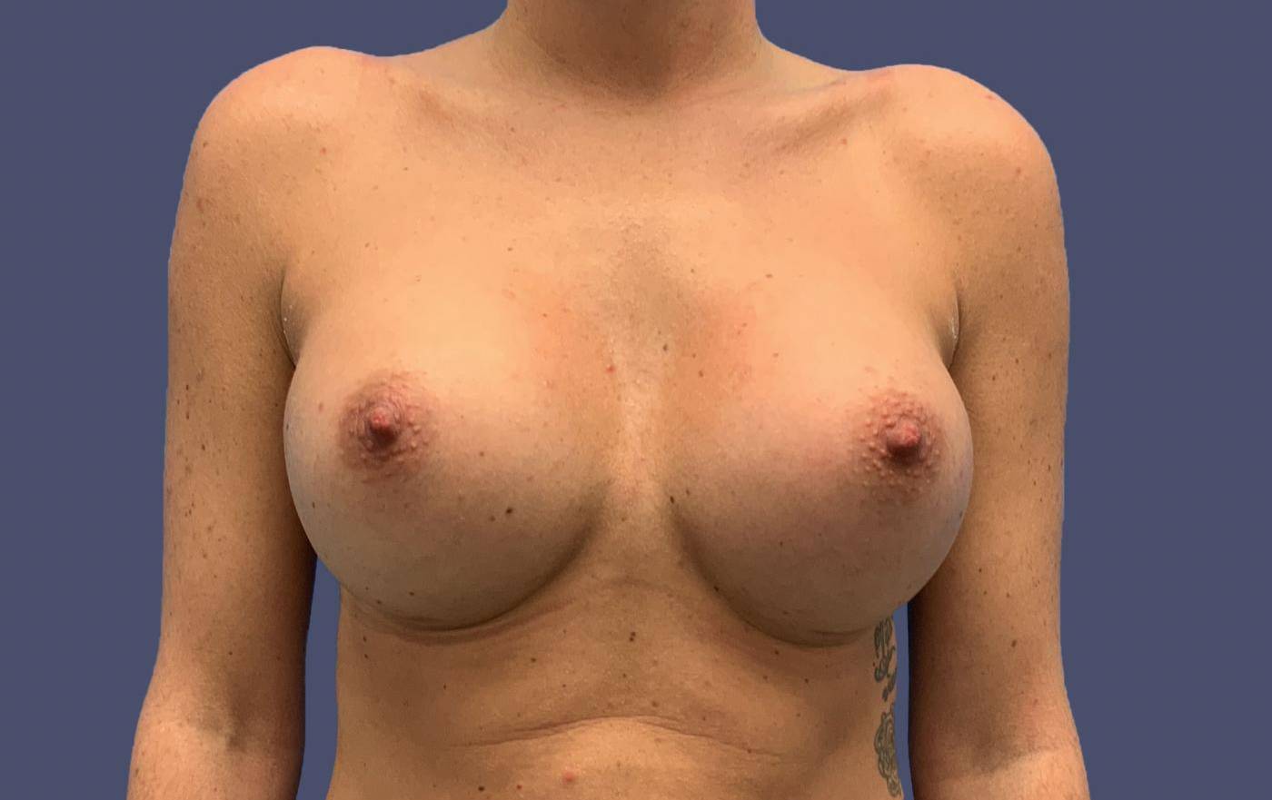 Breast Augmentation 18 After