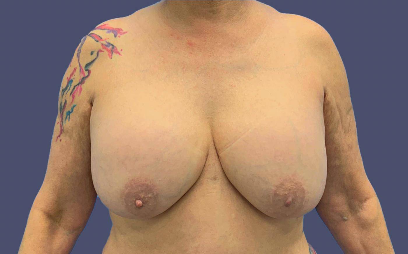 Breast Lift 4 Before