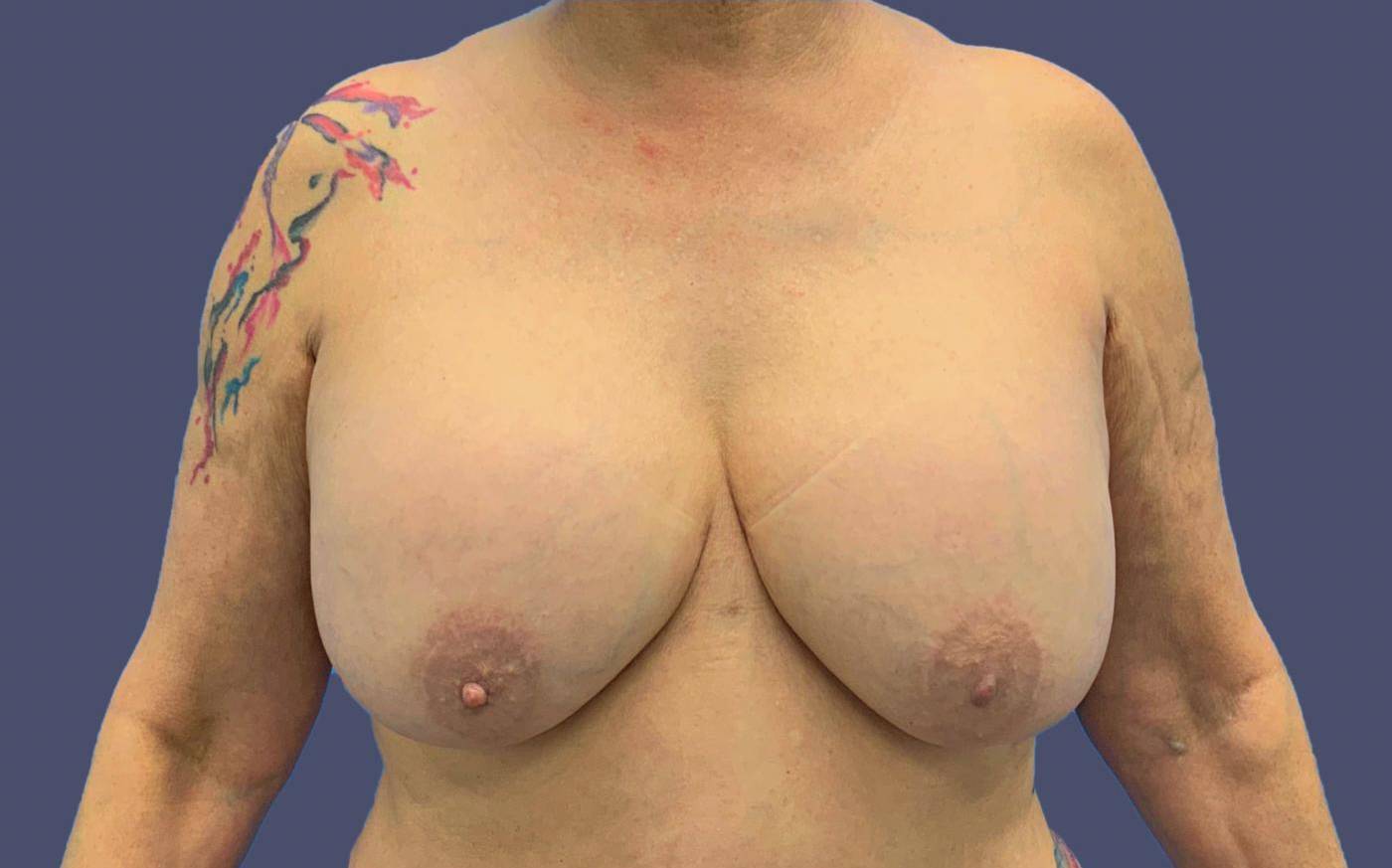 Breast Lift 5 Before