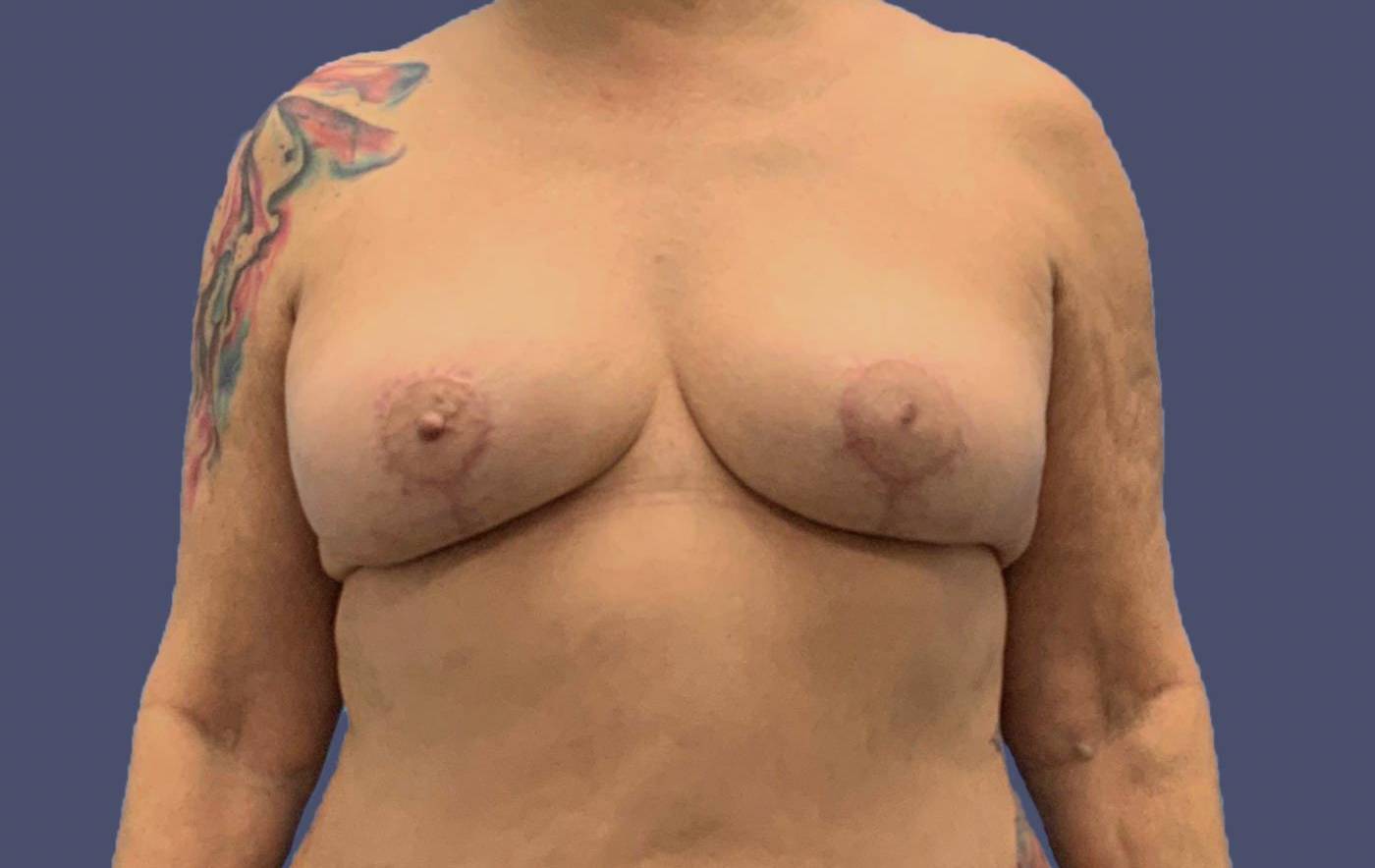 Breast Lift 5 After