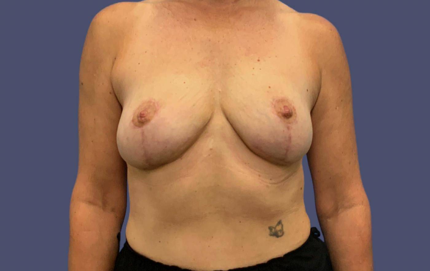 Breast Lift 3 After