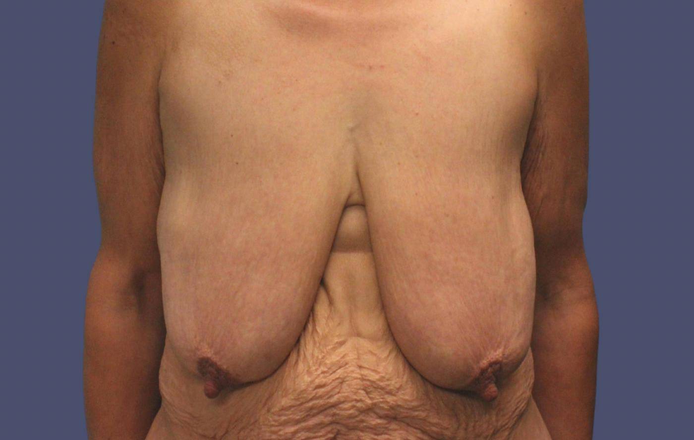 Breast Lift 4 Before