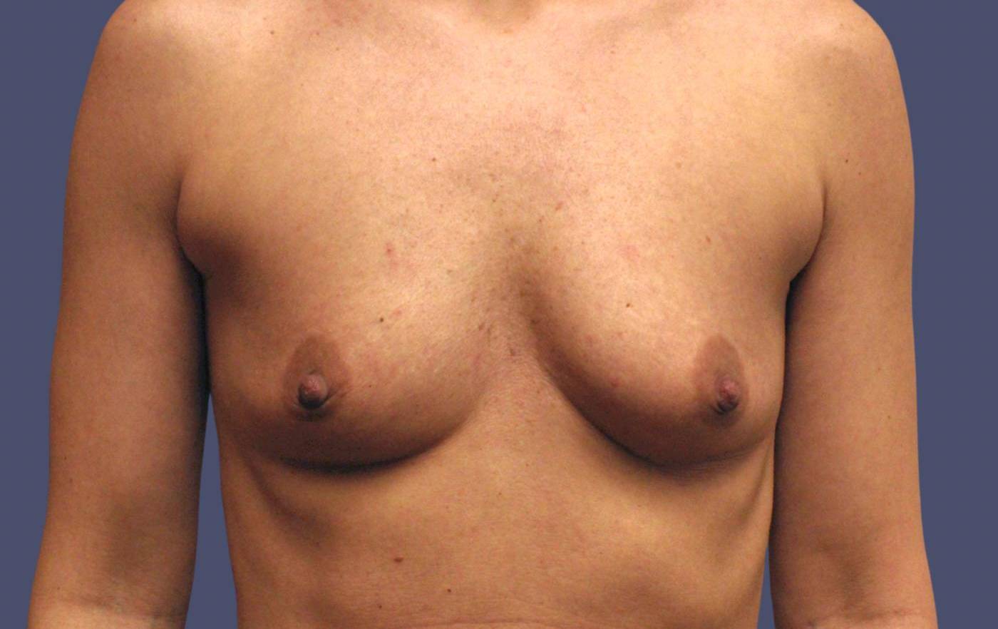 Breast Augmentation 33 Before