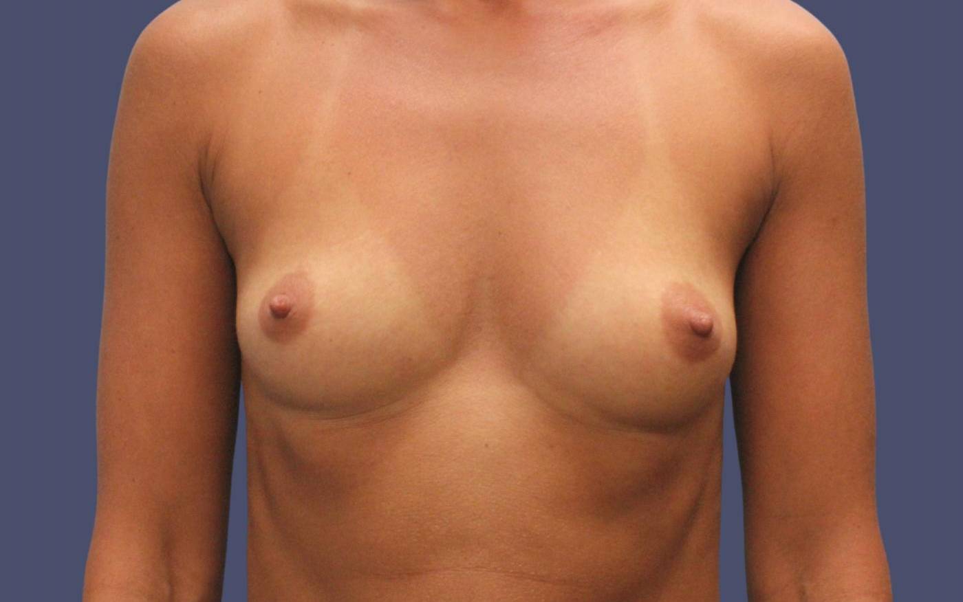 Breast Augmentation 17 Before