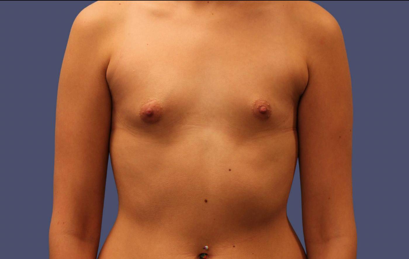 Breast Augmentation 33 Before