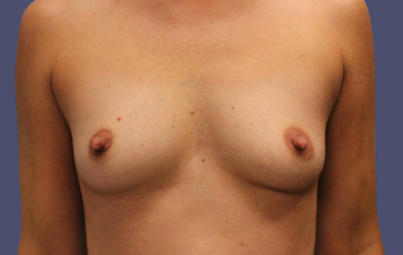 Breast Augmentation 5 Before