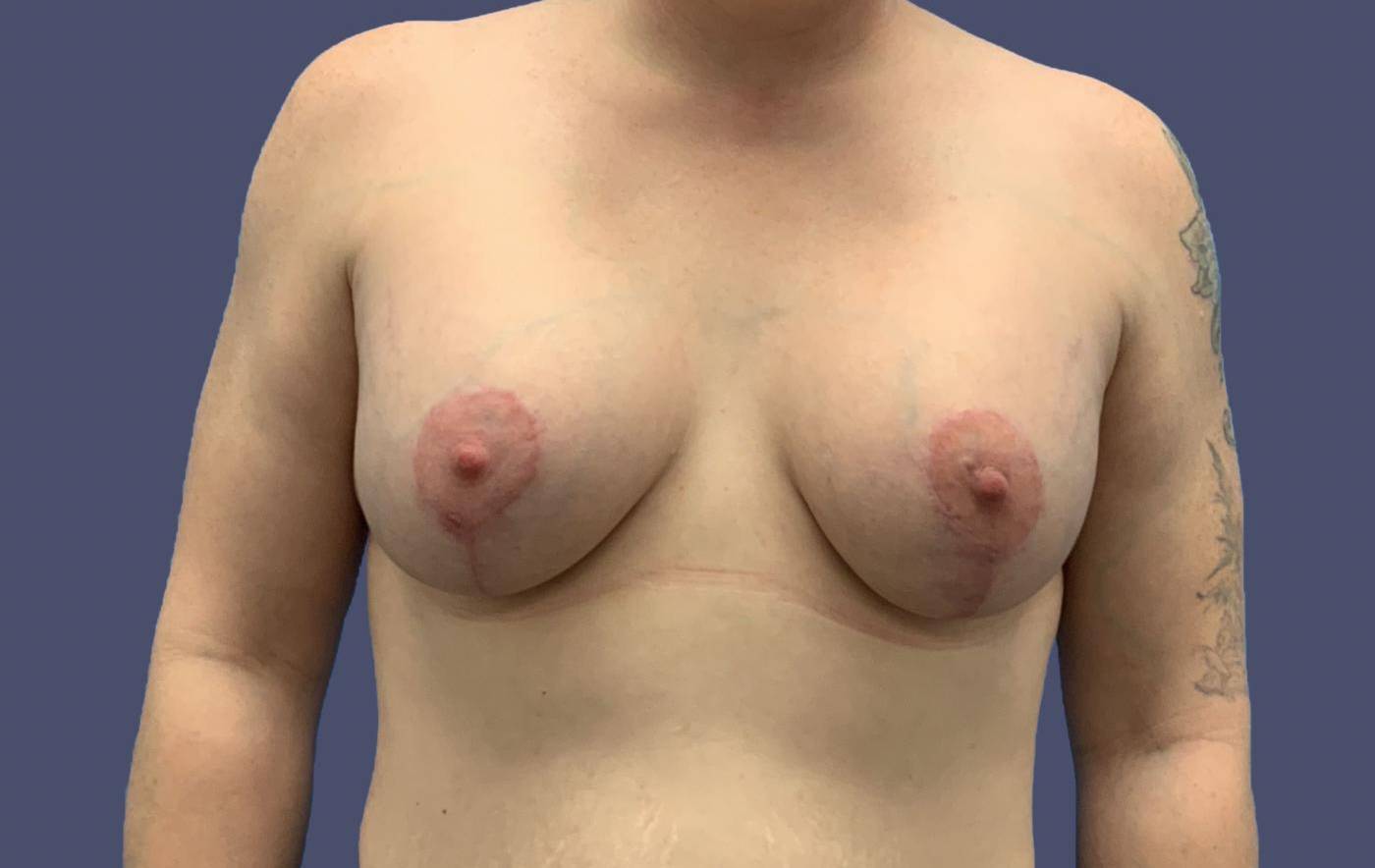 Breast Lift w/Augmentation 18 After