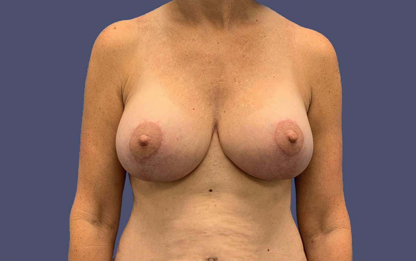 Breast Lift w/ Augmentation 1 After