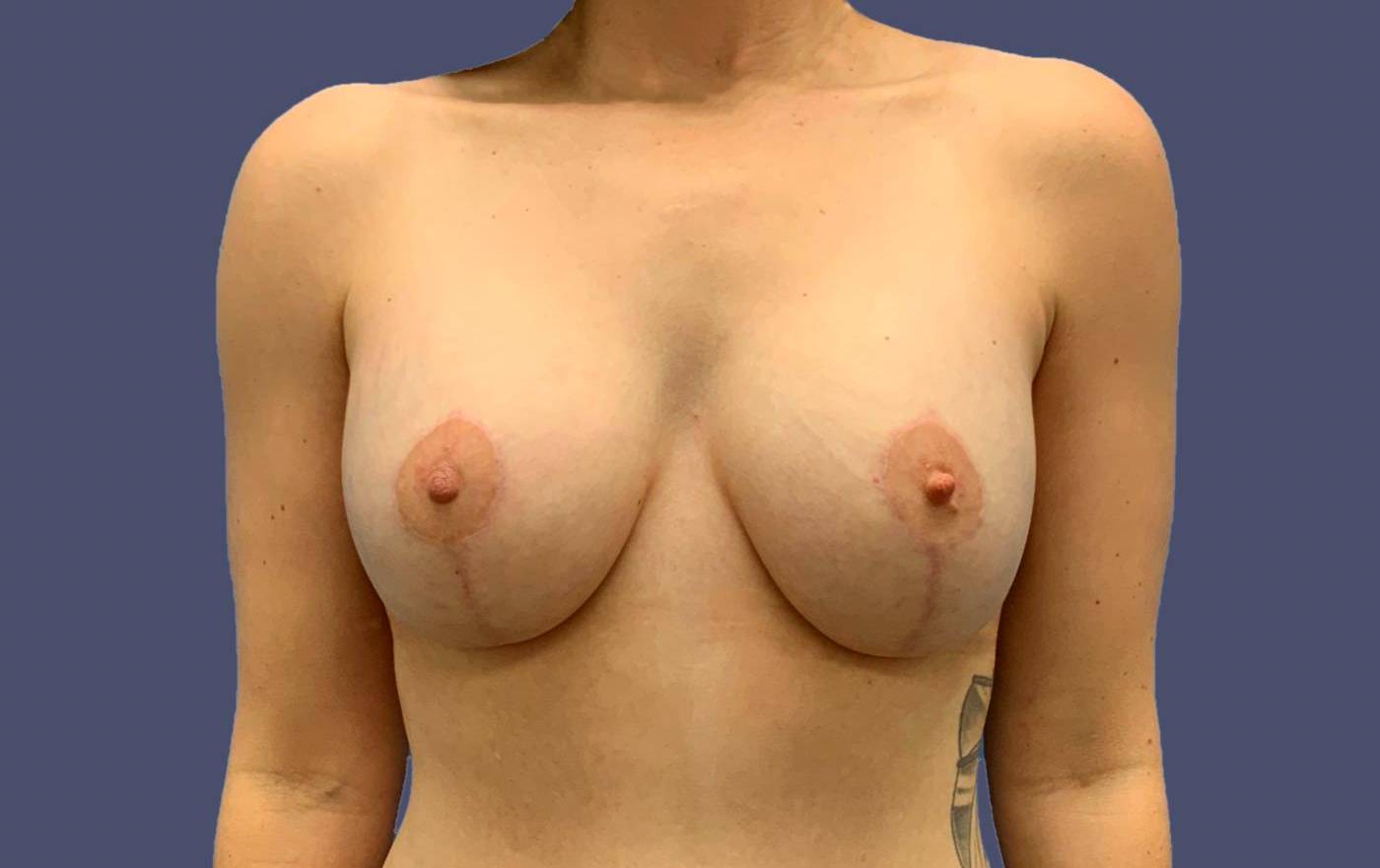 Breast Lift w/ Augmentation 3 After