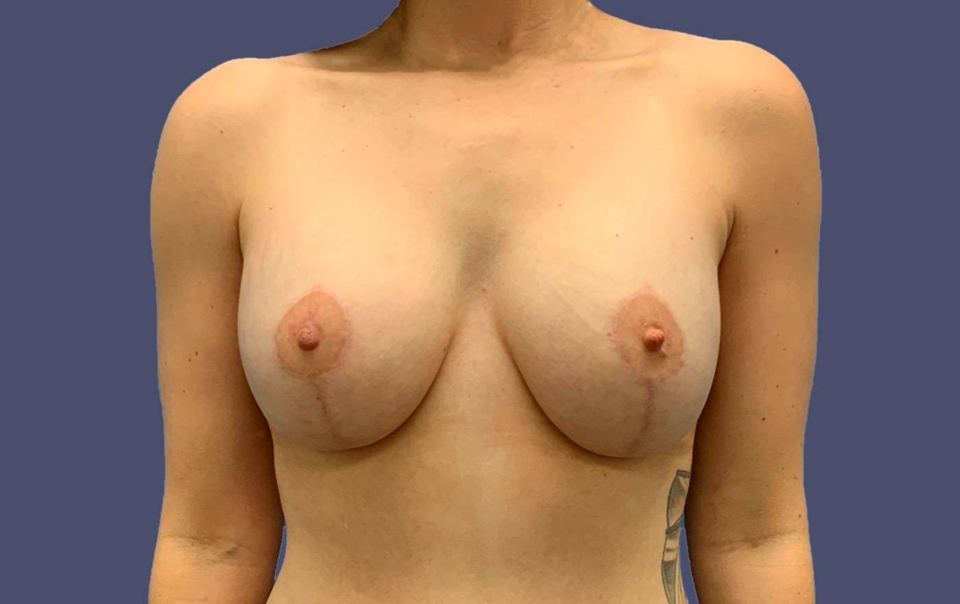 Breast Lift w/ Augmentation 4 After