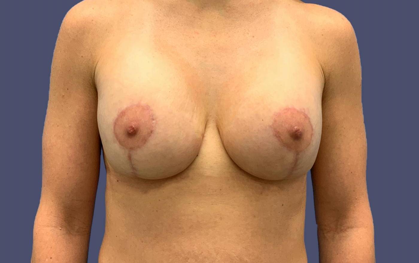 Breast Lift w/ Augmentation 6 After