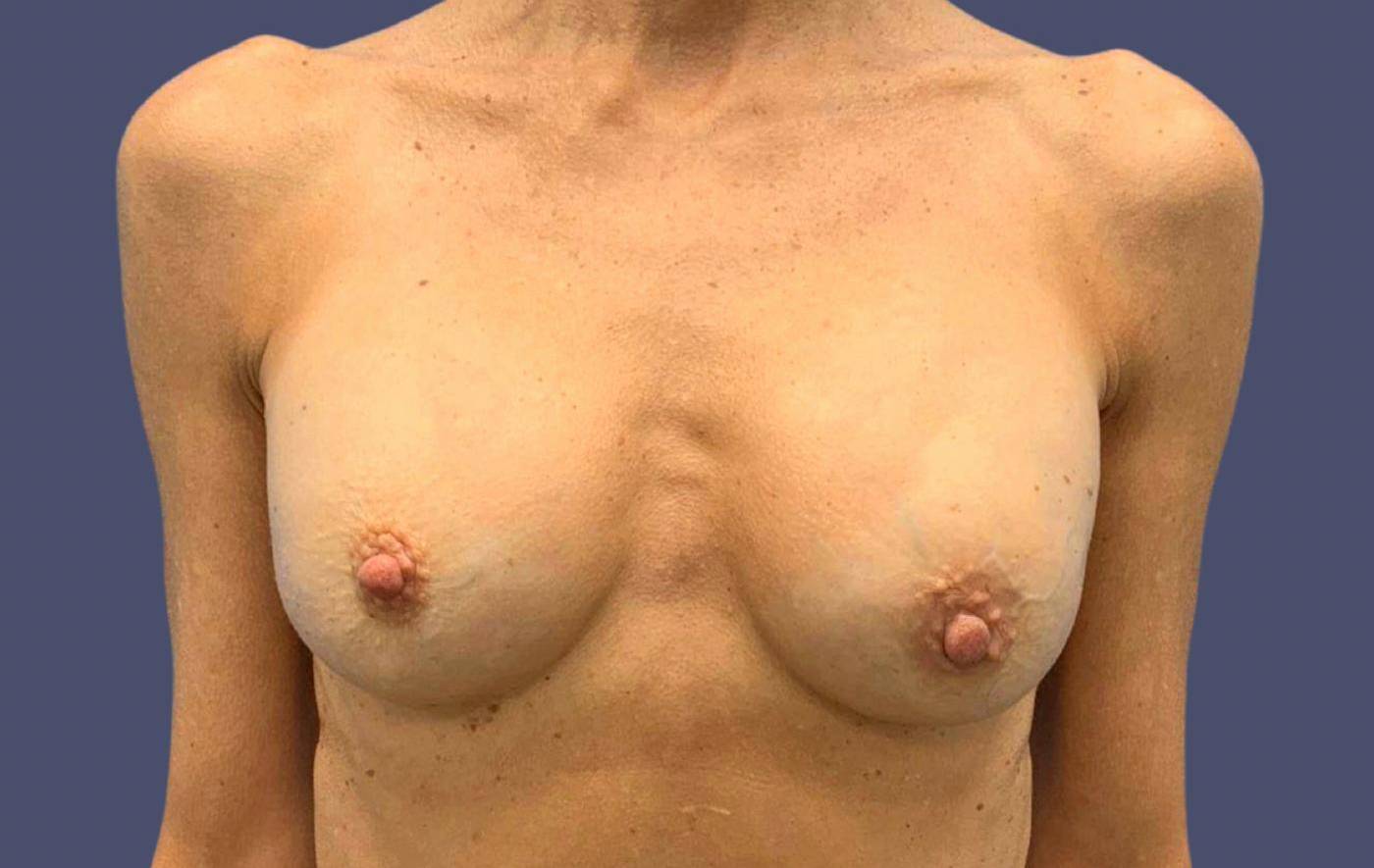 Breast Lift w/ Augmentation 15 Before