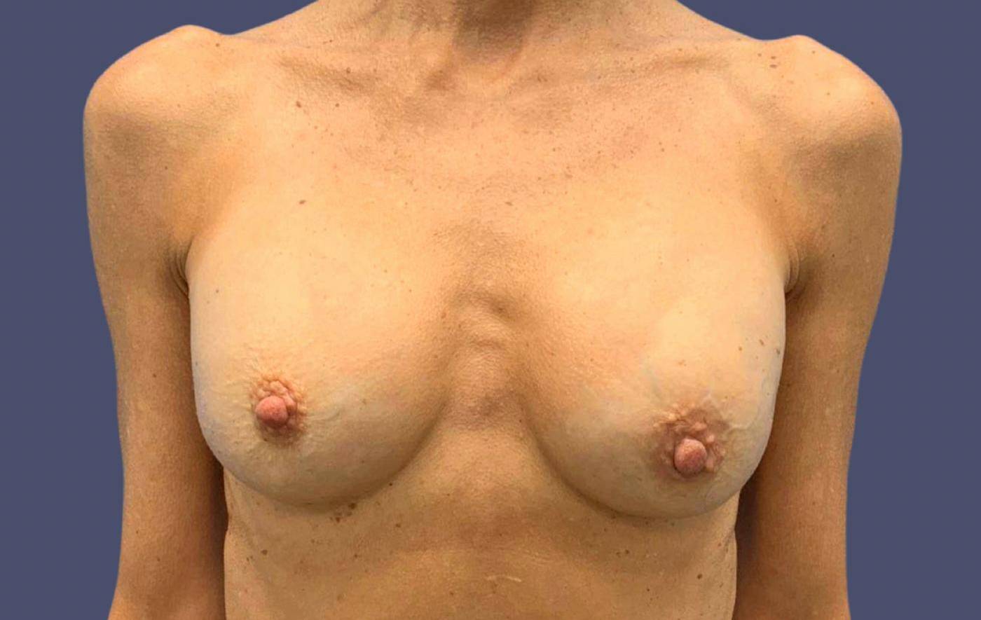Breast Lift w/ Augmentation 19 Before