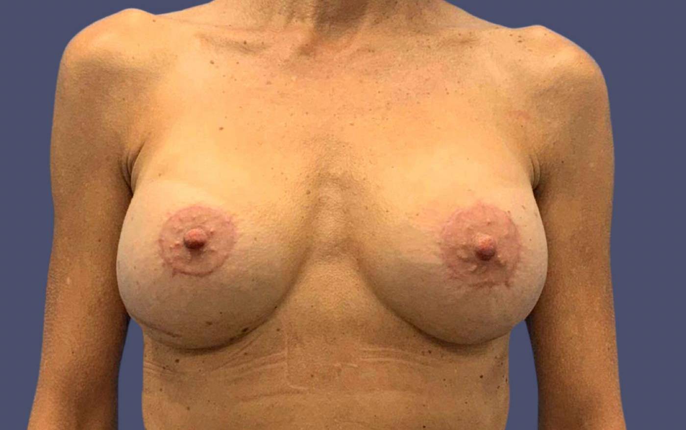 Breast Lift w/ Augmentation 15 After