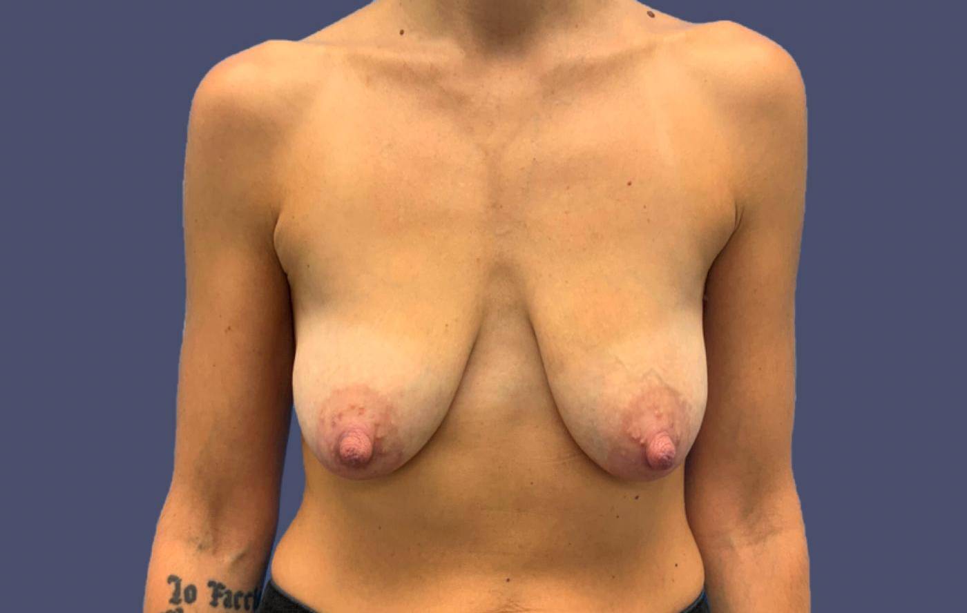 Breast Lift w/ Augmentation 6 Before