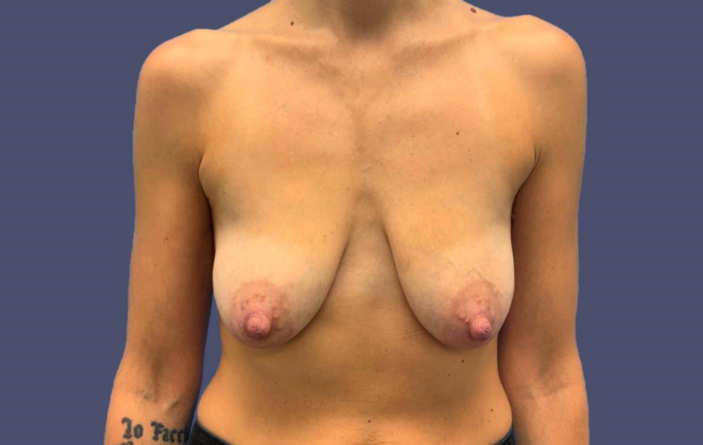 Breast Lift w/ Augmentation 10 Before